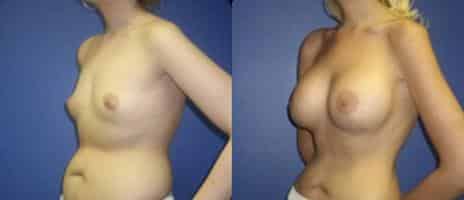 Breast Augmentation Before and After Photos in New York, NY, Patient 10769