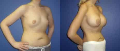 Breast Augmentation Before and After Photos in New York, NY, Patient 10769