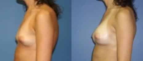 Breast Augmentation Before and After Photos in New York, NY, Patient 10775