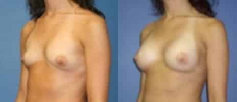 Breast Augmentation Before and After Photos in New York, NY, Patient 10775