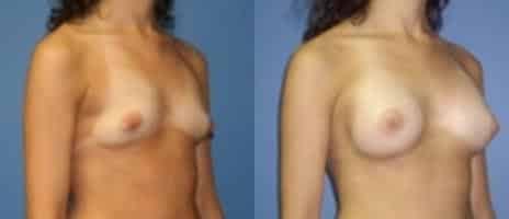 Breast Augmentation Before and After Photos in New York, NY, Patient 10775