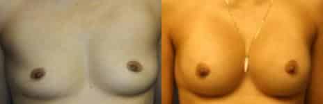 Breast Augmentation Before and After Photos in New York, NY, Patient 10780