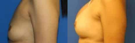 Breast Augmentation Before and After Photos in New York, NY, Patient 10780