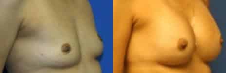 Breast Augmentation Before and After Photos in New York, NY, Patient 10780
