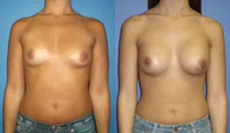 Breast Augmentation Before and After Photos in New York, NY, Patient 10789