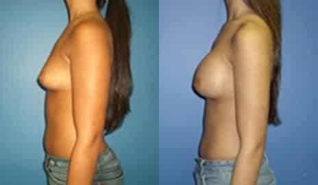 Breast Augmentation Before and After Photos in New York, NY, Patient 10789