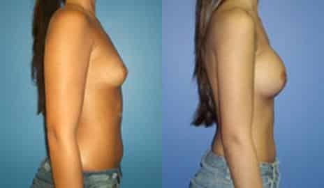 Breast Augmentation Before and After Photos in New York, NY, Patient 10789