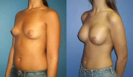 Breast Augmentation Before and After Photos in New York, NY, Patient 10789
