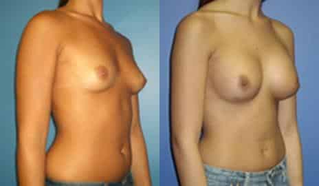Breast Augmentation Before and After Photos in New York, NY, Patient 10789
