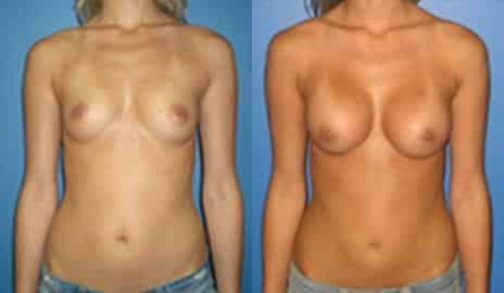 Breast Augmentation Before and After Photos in New York, NY, Patient 10795