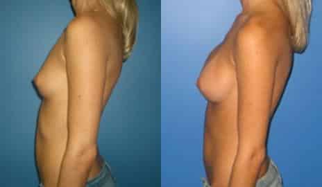 Breast Augmentation Before and After Photos in New York, NY, Patient 10795