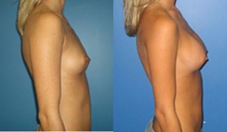 Breast Augmentation Before and After Photos in New York, NY, Patient 10795