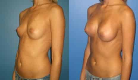 Breast Augmentation Before and After Photos in New York, NY, Patient 10795