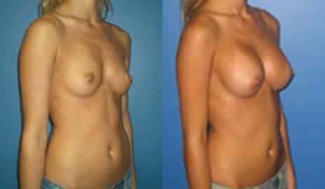 Breast Augmentation Before and After Photos in New York, NY, Patient 10795