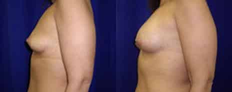 Breast Augmentation Before and After Photos in New York, NY, Patient 10801