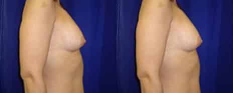 Breast Augmentation Before and After Photos in New York, NY, Patient 10801