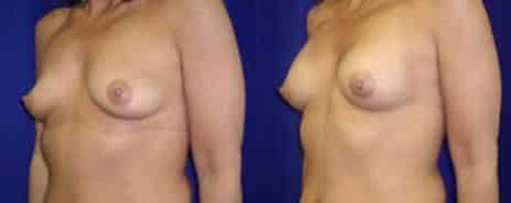 Breast Augmentation Before and After Photos in New York, NY, Patient 10801