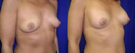 Breast Augmentation Before and After Photos in New York, NY, Patient 10801
