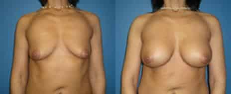 Breast Augmentation Before and After Photos in New York, NY, Patient 10807