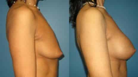 Breast Augmentation Before and After Photos in New York, NY, Patient 10807