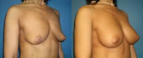 Breast Augmentation Before and After Photos in New York, NY, Patient 10807