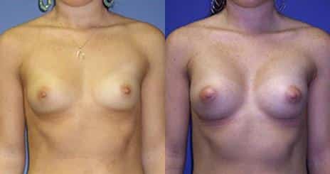 Breast Augmentation Before and After Photos in New York, NY, Patient 10811