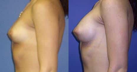 Breast Augmentation Before and After Photos in New York, NY, Patient 10811