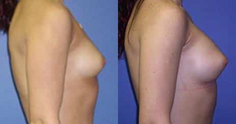 Breast Augmentation Before and After Photos in New York, NY, Patient 10811
