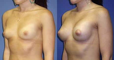 Breast Augmentation Before and After Photos in New York, NY, Patient 10811