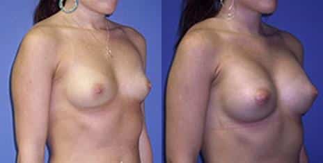 Breast Augmentation Before and After Photos in New York, NY, Patient 10811