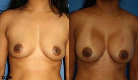 Breast Augmentation Before and After Photos in New York, NY, Patient 10817