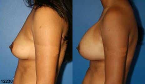 Breast Augmentation Before and After Photos in New York, NY, Patient 10817