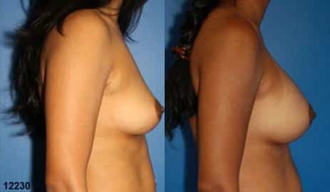 Breast Augmentation Before and After Photos in New York, NY, Patient 10817