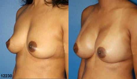 Breast Augmentation Before and After Photos in New York, NY, Patient 10817