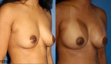Breast Augmentation Before and After Photos in New York, NY, Patient 10817