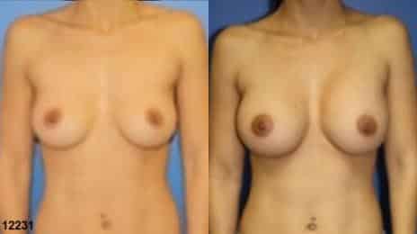 Breast Augmentation Before and After Photos in New York, NY, Patient 10823