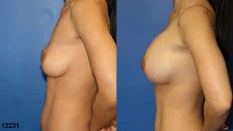 Breast Augmentation Before and After Photos in New York, NY, Patient 10823