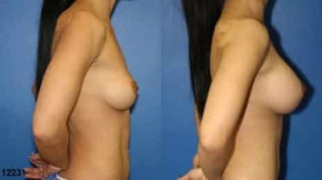 Breast Augmentation Before and After Photos in New York, NY, Patient 10823
