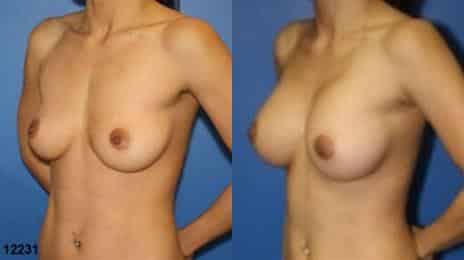 Breast Augmentation Before and After Photos in New York, NY, Patient 10823
