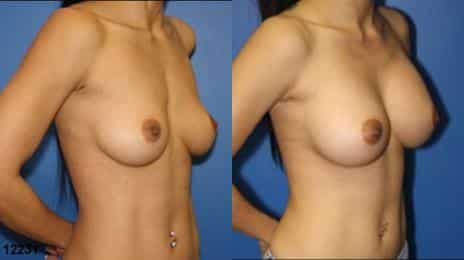 Breast Augmentation Before and After Photos in New York, NY, Patient 10823