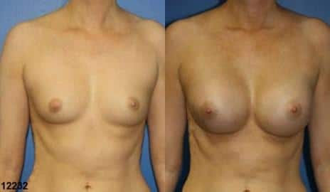 Breast Augmentation Before and After Photos in New York, NY, Patient 10829