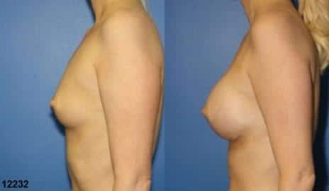 Breast Augmentation Before and After Photos in New York, NY, Patient 10829