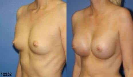 Breast Augmentation Before and After Photos in New York, NY, Patient 10829