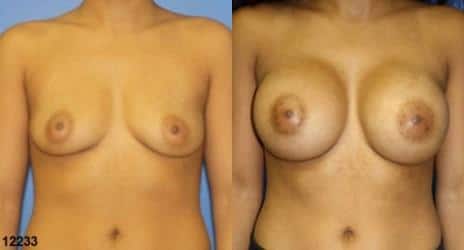 Breast Augmentation Before and After Photos in New York, NY, Patient 10836