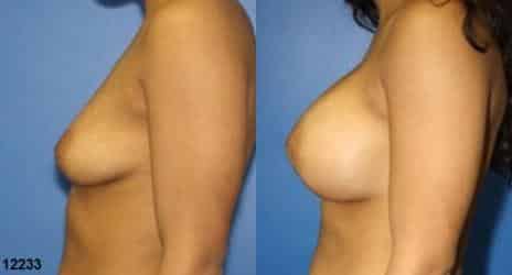 Breast Augmentation Before and After Photos in New York, NY, Patient 10836