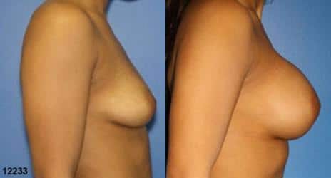 Breast Augmentation Before and After Photos in New York, NY, Patient 10836