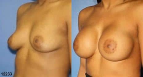 Breast Augmentation Before and After Photos in New York, NY, Patient 10836