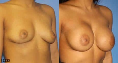 Breast Augmentation Before and After Photos in New York, NY, Patient 10836