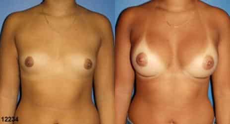 Patient 10843, Breast Augmentation Before and After Photos Breast Augmentation Before and After Photos in New York, NY, Patient 10843