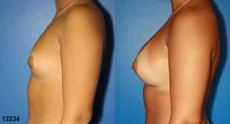 Patient 10843, Breast Augmentation Before and After Photos Breast Augmentation Before and After Photos in New York, NY, Patient 10843